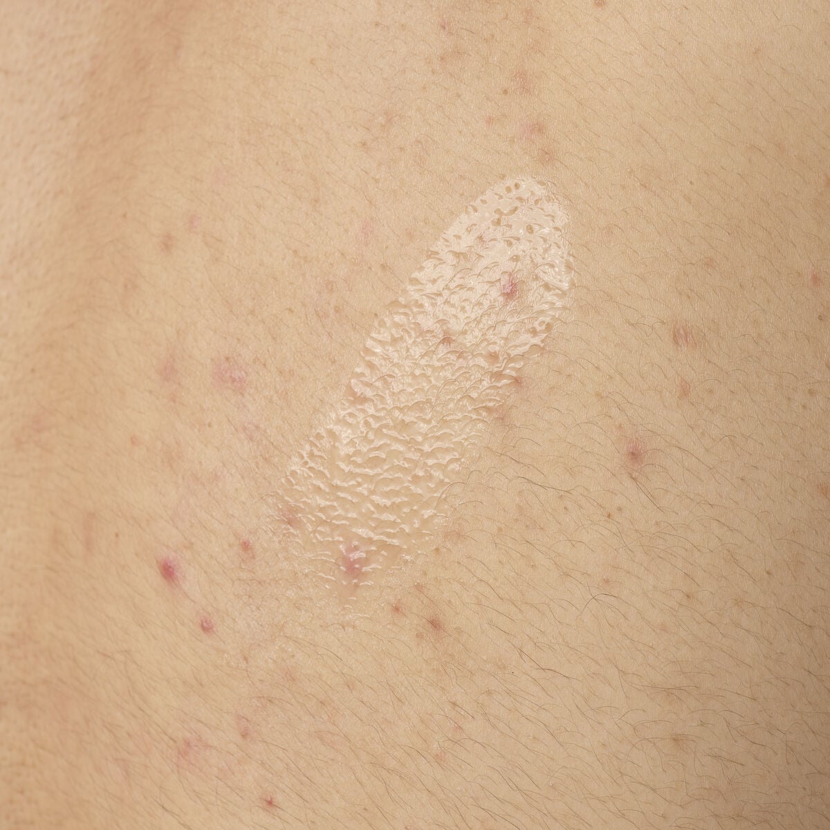 Close-up texture shot of The Ordinary Salicylic Acid 0.5 parts per hundred Body Serum. The clear, lightweight gel is shown applied directly to skin with some visible body acne, demonstrating its consistency.